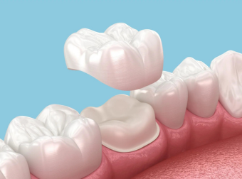 Crown Treatment Steps